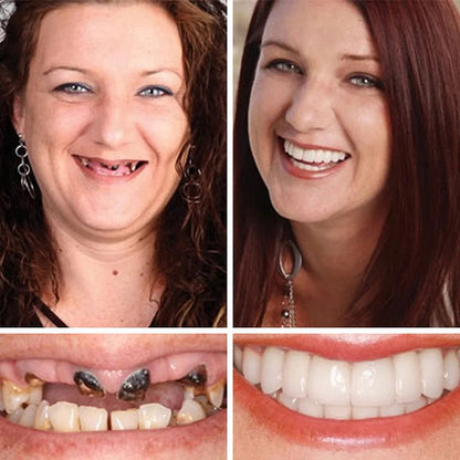 '-Ends Today: 70% OFF! ⏰DarkFairy™  Medical Full Denture with Strong Suctiond Custom-Fit Full Functional Dentures🦷Obtain American Dental Association (ADA) Certification
