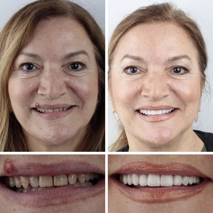 '-Ends Today: 70% OFF! ⏰DarkFairy™  Medical Full Denture with Strong Suctiond Custom-Fit Full Functional Dentures🦷Obtain American Dental Association (ADA) Certification