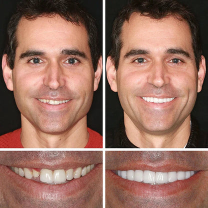 '-Ends Today: 70% OFF! ⏰DarkFairy™  Medical Full Denture with Strong Suctiond Custom-Fit Full Functional Dentures🦷Obtain American Dental Association (ADA) Certification
