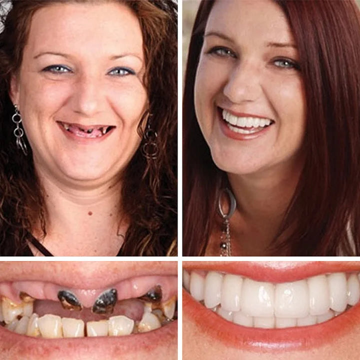 Ends Today: 70% OFF  Custom-Fit Full Functional Dentures